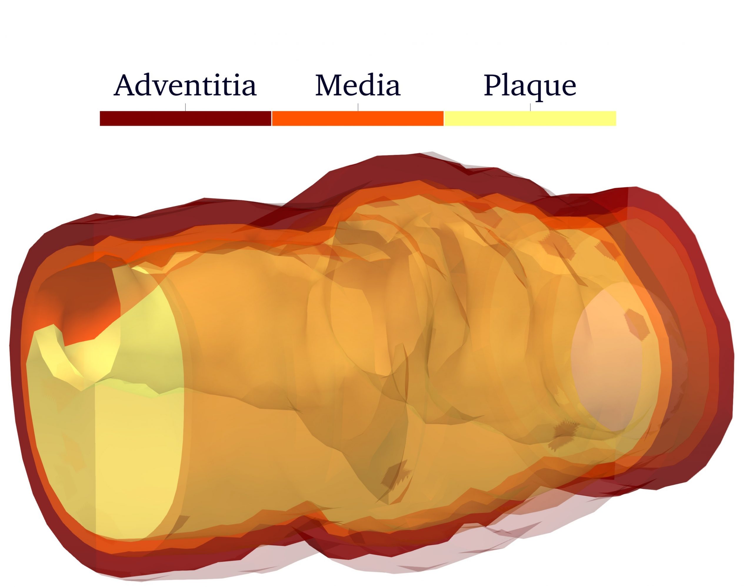 Modeling and simulation of pharmaco-mechanical fluid-structure interaction for an enhanced treatment of cardiovascular diseases